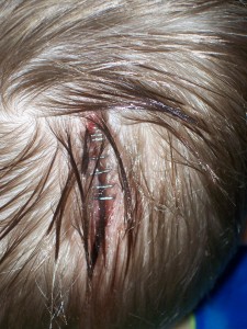 Aiden's six staples.